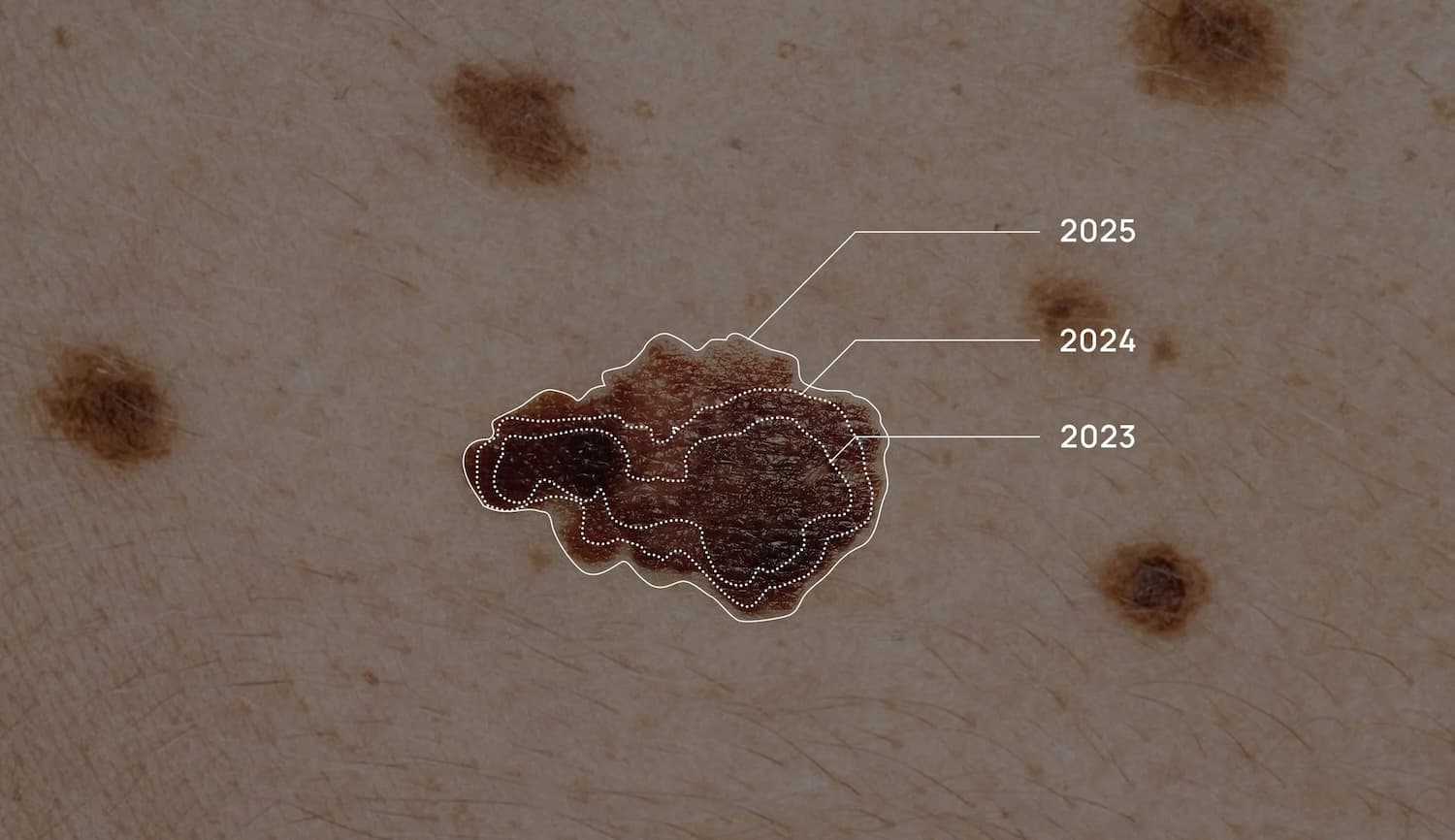 Skin mole with outlines showing changes in shape and color across years 2023, 2024, and 2025.